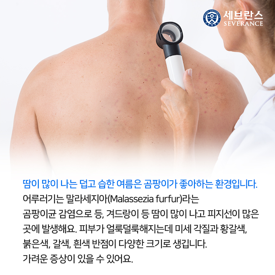 땀이 많이 나는 덥고 습한 여름은 곰팡이가 좋아하는 환경입니다. 어루러기는 말라세지아(Malassezia furfur)라는 곰팡이균 감염으로 등, 겨드랑이 등 땀이 많이 나고 피지선이 많은 곳에 발생해요.  피부가 얼룩덜룩해지는데 미세 각질과 황갈색, 붉은색, 갈색, 흰색 반점이 다양한 크기로 생깁니다.  가려운 증상이 있을 수 있어요.