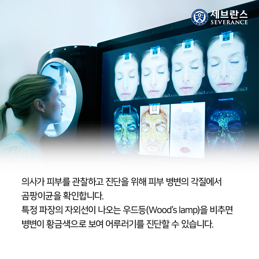 의사가 피부를 관찰하고 진단을 위해 피부 병변의 각질에서 곰팡이균을 확인합니다.  특정 파장의 자외선이 나오는 우드등(Wood’s lamp)을 비추면 병변이 황금색으로 보여 어루러기를 진단할 수 있습니다. 
