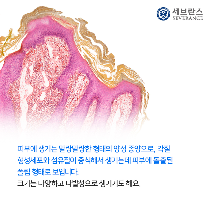 피부에 생기는 말랑말랑한 형태의 양성 종양으로, 각질 형성세포와 섬유질이 증식해서 생기는데 피부에 돌출된 폴립 형태로 보입니다. 크기는 다양하고 다발성으로 생기기도 해요.