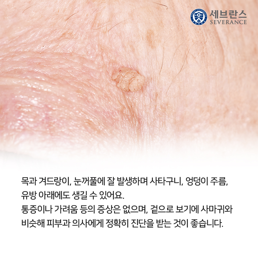 목과 겨드랑이, 눈꺼풀에 잘 발생하며 사타구니, 엉덩이 주름, 유방 아래에도 생길 수 있어요. 통증이나 가려움 등의 증상은 없으며, 겉으로 보기에 사마귀와 비슷해 피부과 의사에게 정확히 진단을 받는 것이 좋습니다.