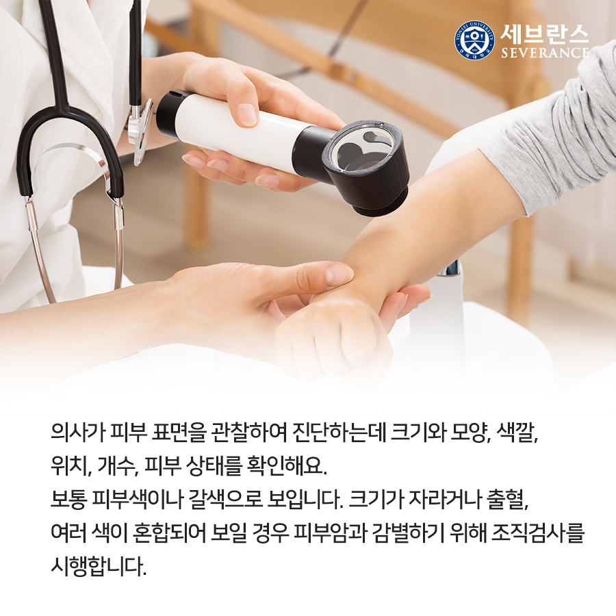 의사가 피부 표면을 관찰하여 진단하는데 크기와 모양, 색깔, 위치, 개수, 피부 상태를 확인해요. 보통 피부색이나 갈색으로 보입니다. 크기가 자라거나 출혈, 여러 색이 혼합되어 보일 경우 피부암과 감별하기 위해 조직검사를 시행합니다.