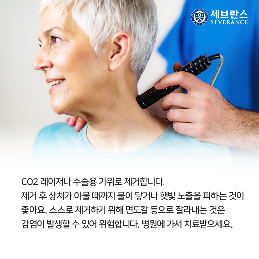 CO2 레이저나 수술용 가위로 제거합니다. 제거 후 상처가 아물 때까지 물이 닿거나 햇빛 노출을 피하는 것이 좋아요. 스스로 제거하기 위해 면도칼 등으로 잘라내는 것은 감염이 발생할 수 있어 위험합니다. 병원에 가서 치료받으세요.