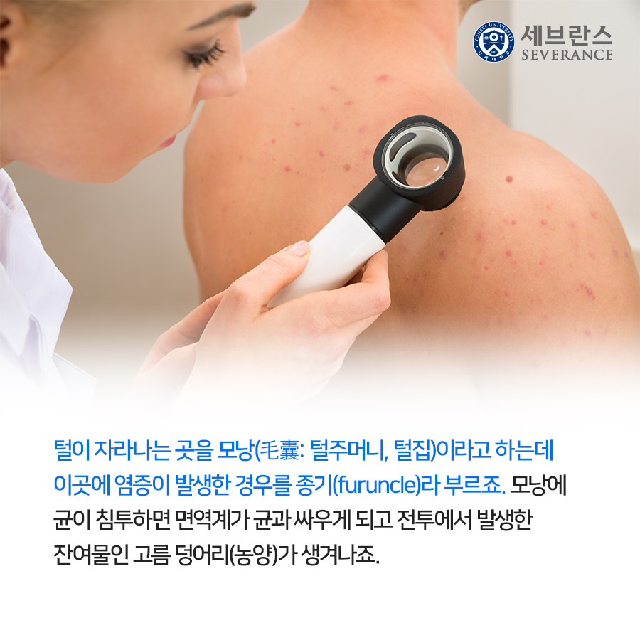 털이 자라나는 곳을 모낭(毛囊: 털주머니, 털집)이라고 하는데 이곳에 염증이 발생한 경우를 종기(furuncle)라 부르죠. 모낭에 균이 침투하면 면역계가 균과 싸우게 되고 전투에서 발생한 잔여물인 고름 덩어리(농양)가 생겨나죠.