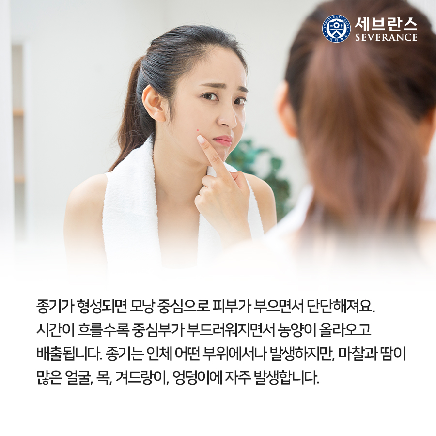 종기가 형성되면 모낭 중심으로 피부가 부으면서 단단해져요. 시간이 흐를수록 중심부가 부드러워지면서 농양이 올라오고 배출됩니다. 종기는 인체 어떤 부위에서나 발생하지만, 마찰과 땀이 많은 얼굴, 목, 겨드랑이, 엉덩이에 자주 발생합니다.