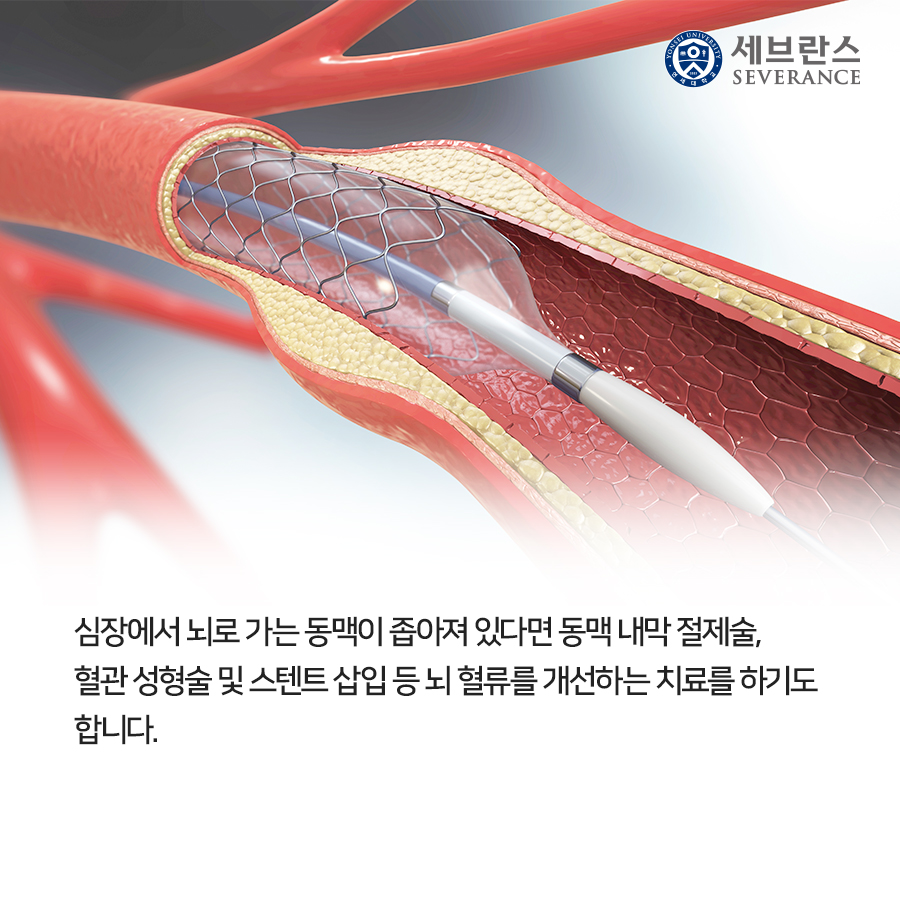 혈관성 치매는 예방할 순 있지만 일단 발생하면 치료가 어렵습니다. 우선 뇌혈관의 회복에 집중합니다. 아스피린, 와파린과 같은 항응고제, 혈류순환 개선제를 복용합니다. 기억력 훈련, 재활 치료도 진행합니다. 
