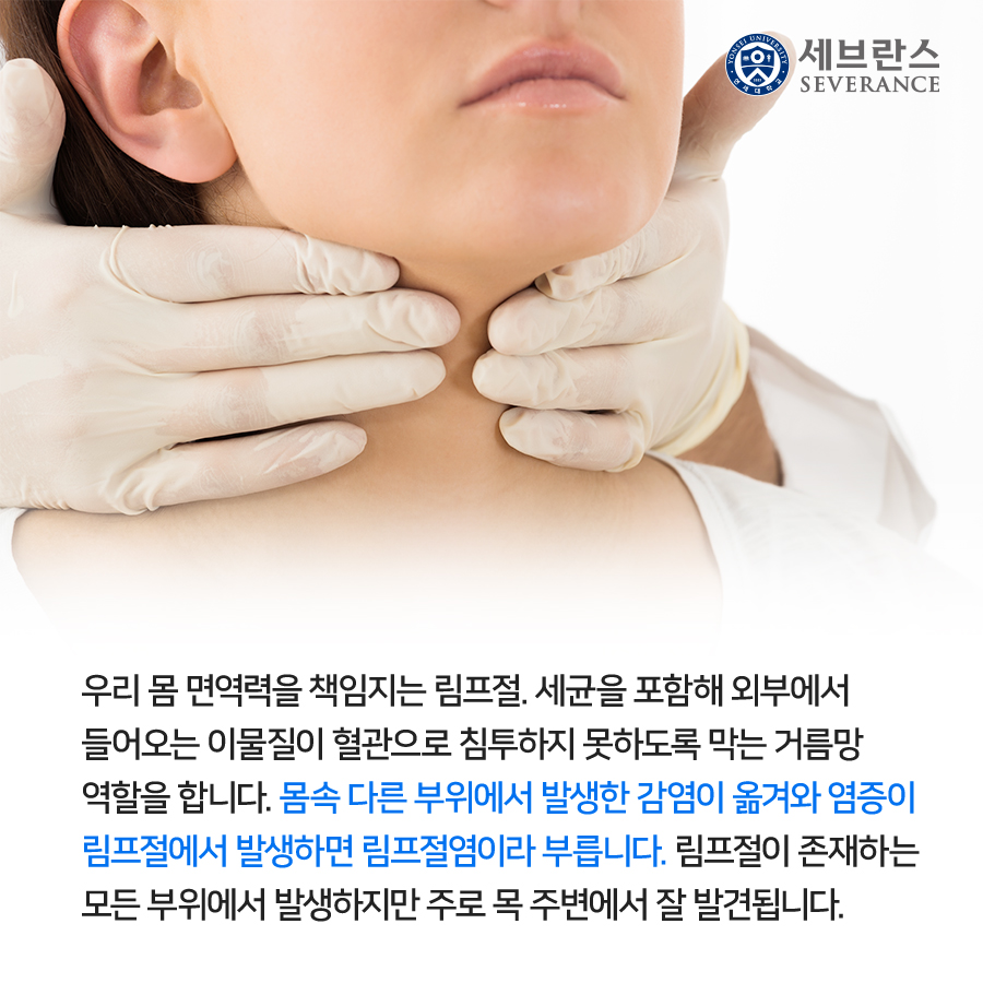 우리 몸 면역력을 책임지는 림프절. 세균을 포함해 외부에서 들어오는 이물질이 혈관으로 침투하지 못하도록 막는 거름망 역할을 합니다. 몸속 다른 부위에서 발생한 감염이 옮겨와 염증이 림프절에서 발생하면 림프절염이라 부릅니다. 림프절이 존재하는 모든 부위에서 발생하지만 주로 목 주변에서 잘 발견됩니다.