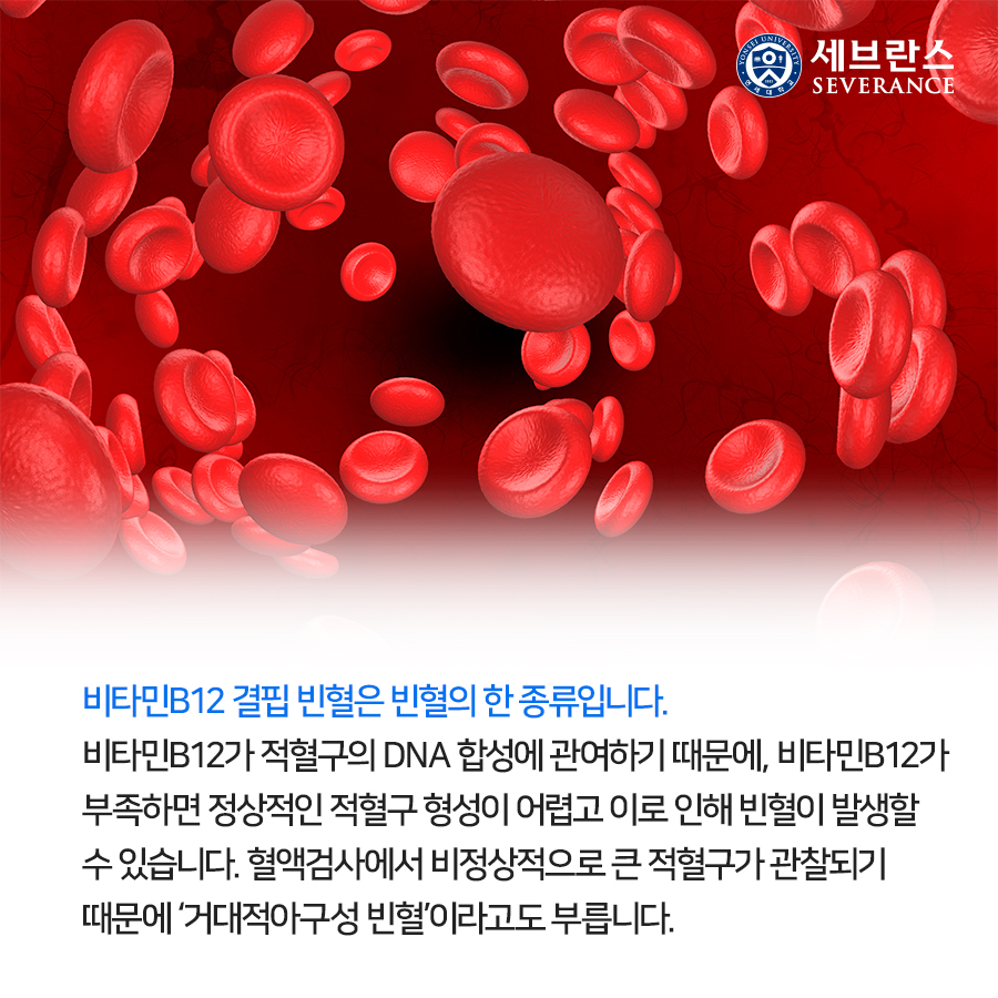 비타민B12 결핍 빈혈은 빈혈의 한 종류입니다. 비타민B12가 적혈구의 DNA 합성에 관여하기 때문에, 비타민B12가 부족하면 정상적인 적혈구 형성이 어렵고 이로 인해 빈혈이 발생할 수 있습니다. 혈액검사에서 비정상적으로 큰 적혈구가 관찰되기 때문에 ‘거대적아구성 빈혈’이라고도 부릅니다.