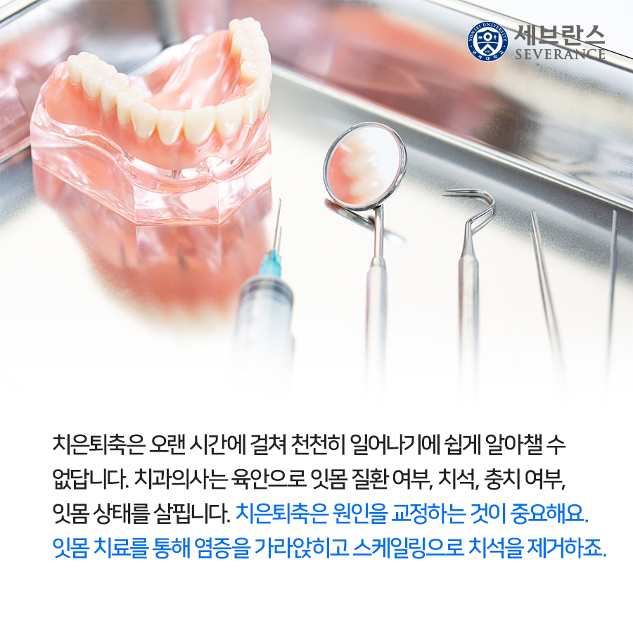 치은퇴축은 오랜 시간에 걸쳐 천천히 일어나기에 쉽게 알아챌 수 없답니다. 치과의사는 육안으로 잇몸 질환 여부, 치석, 충치 여부, 잇몸 상태를 살핍니다. 치은퇴축은 원인을 교정하는 것이 중요해요. 잇몸 치료를 통해 염증을 가라앉히고 스케일링으로 치석을 제거하죠.