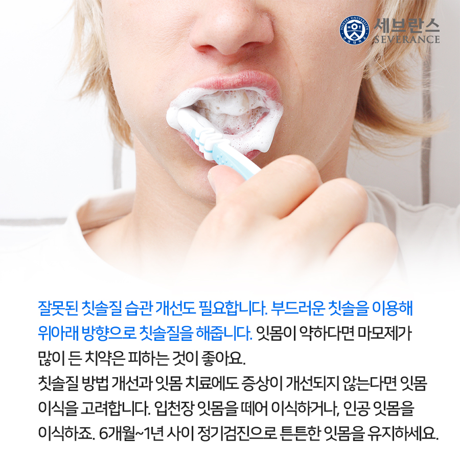 잘못된 칫솔질 습관 개선도 필요합니다. 부드러운 칫솔을 이용해 위아래 방향으로 칫솔질을 해줍니다. 잇몸이 약하다면 마모제가 많이 든 치약은 피하는 것이 좋아요.  칫솔질 방법 개선과 잇몸 치료에도 증상이 개선되지 않는다면 잇몸 이식을 고려합니다. 입천장 잇몸을 떼어 이식하거나, 인공 잇몸을 이식하죠. 6개월~1년 사이 정기검진으로 튼튼한 잇몸을 유지하세요. 
