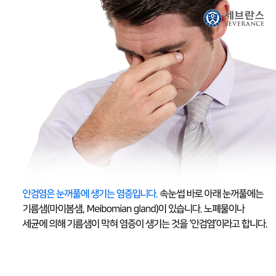 안검염은 눈꺼풀에 생기는 염증입니다. 속눈썹 바로 아래 눈꺼풀에는 기름샘(마이봄샘, Meibomian gland)이 있습니다. 노폐물이나 세균에 의해 기름샘이 막혀 염증이 생기는 것을 ‘안검염’이라고 합니다.