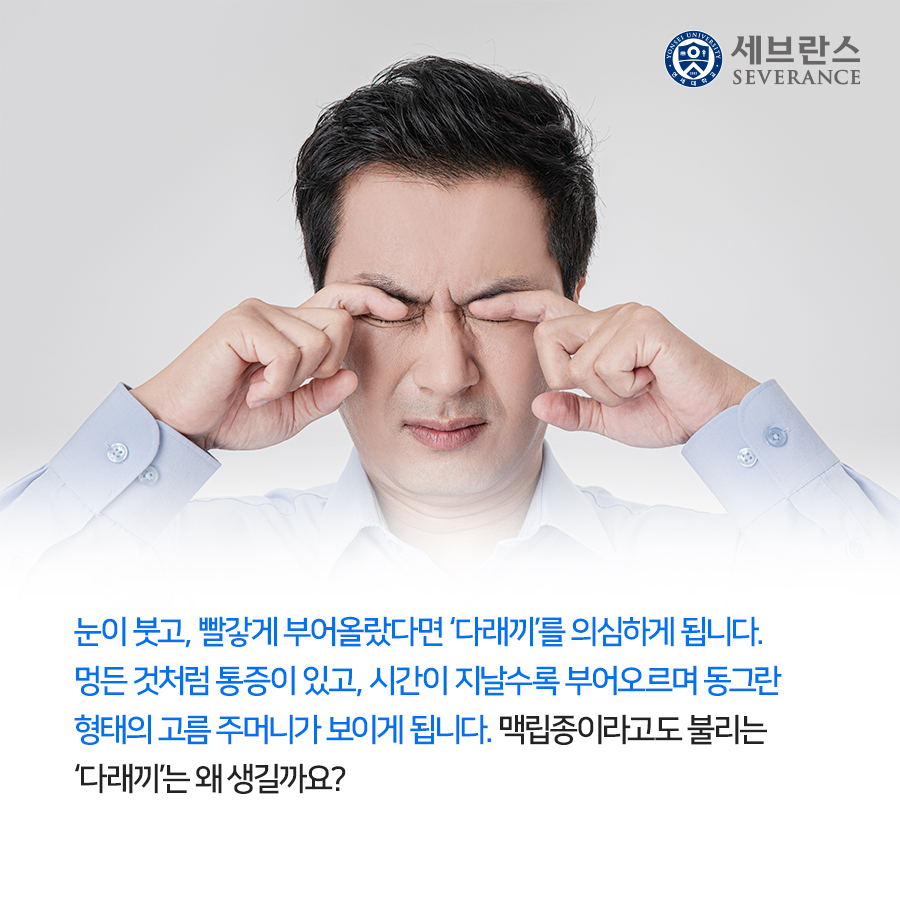눈이 붓고, 빨갛게 부어올랐다면 ‘다래끼’를 의심하게 됩니다. 멍든 것처럼 통증이 있고, 시간이 지날수록 부어오르며 동그란 형태의 고름 주머니가 보이게 됩니다. 맥립종이라고도 불리는 ‘다래끼’는 왜 생길까요?