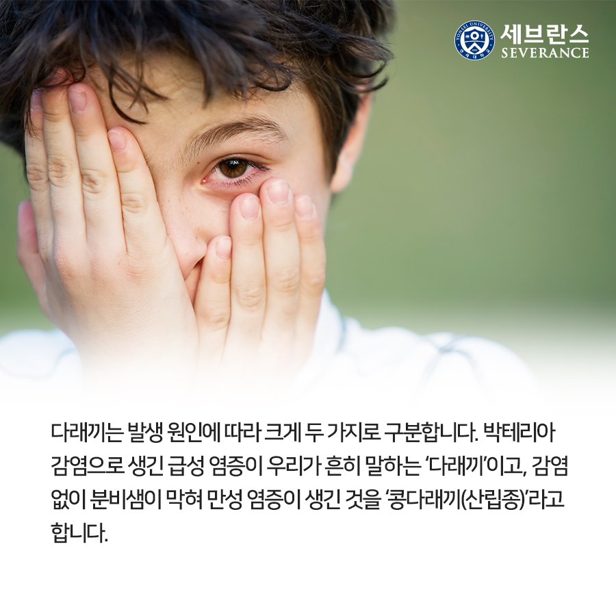 다래끼는 발생 원인에 따라 크게 두 가지로 구분합니다. 박테리아 감염으로 생긴 급성 염증이 우리가 흔히 말하는 ‘다래끼’이고, 감염 없이 분비샘이 막혀 만성 염증이 생긴 것을 ‘콩다래끼(산립종)’라고 합니다. 