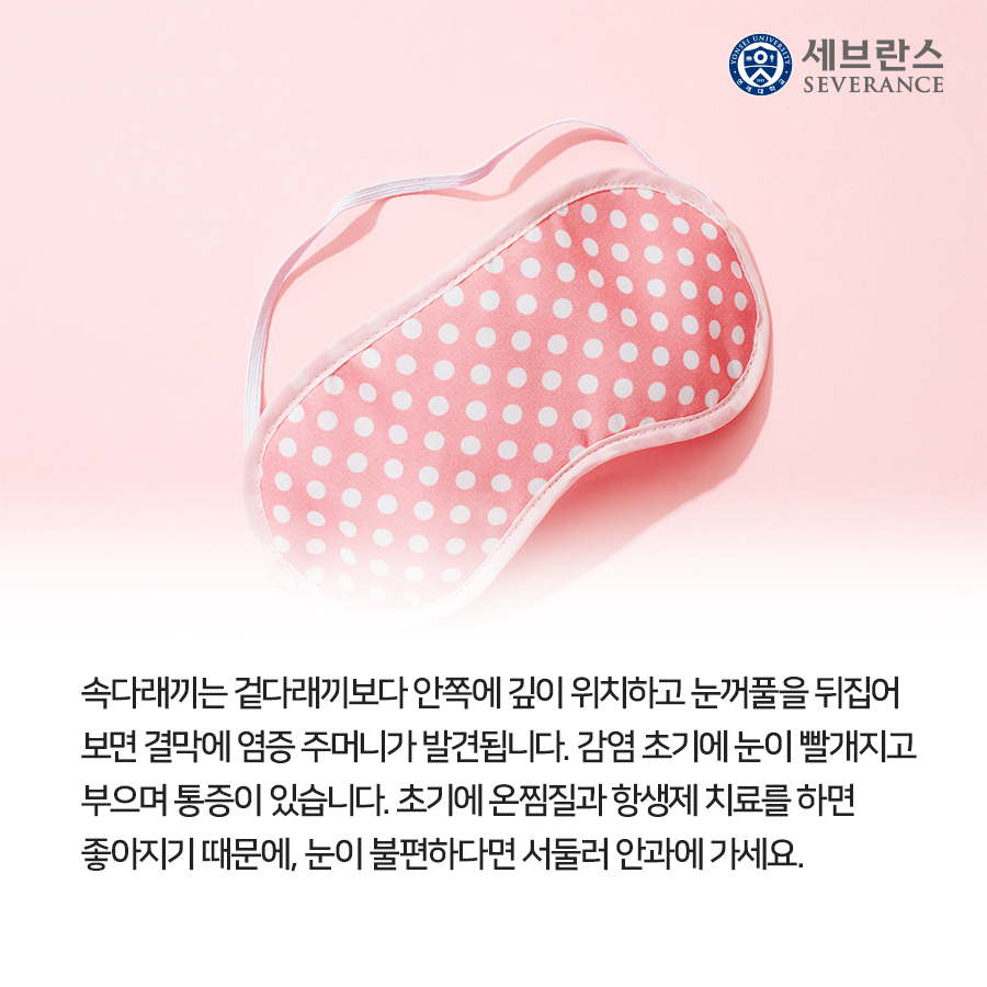 속다래끼는 겉다래끼보다 안쪽에 깊이 위치하고 눈꺼풀을 뒤집어 보면 결막에 염증 주머니가 발견됩니다. 감염 초기에 눈이 빨개지고 부으며 통증이 있습니다. 초기에 온찜질과 항생제 치료를 하면 좋아지기 때문에, 눈이 불편하다면 서둘러 안과에 가세요. 