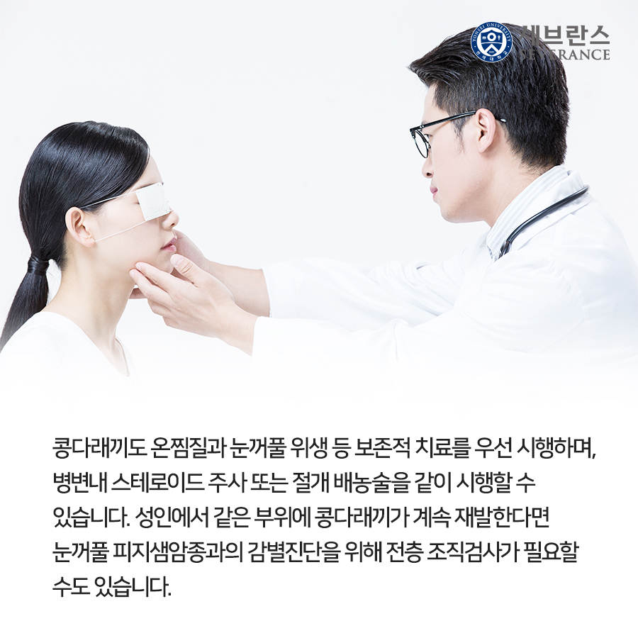 콩다래끼도 온찜질과 눈꺼풀 위생 등 보존적 치료를 우선 시행하며, 병변내 스테로이드 주사 또는 절개 배농술을 같이 시행할 수 있습니다. 성인에서 같은 부위에 콩다래끼가 계속 재발한다면 눈꺼풀 피지샘암종과의 감별진단을 위해 전층 조직검사가 필요할 수도 있습니다.