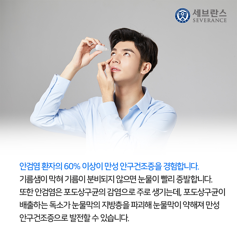 안검염 환자의 60% 이상이 만성 안구건조증을 경험합니다. 기름샘이 막혀 기름이 분비되지 않으면 눈물이 빨리 증발합니다. 또한 안검염은 포도상구균의 감염으로 주로 생기는데, 포도상구균이 배출하는 독소가 눈물막의 지방층을 파괴해 눈물막이 약해져 만성 안구건조증으로 발전할 수 있습니다.