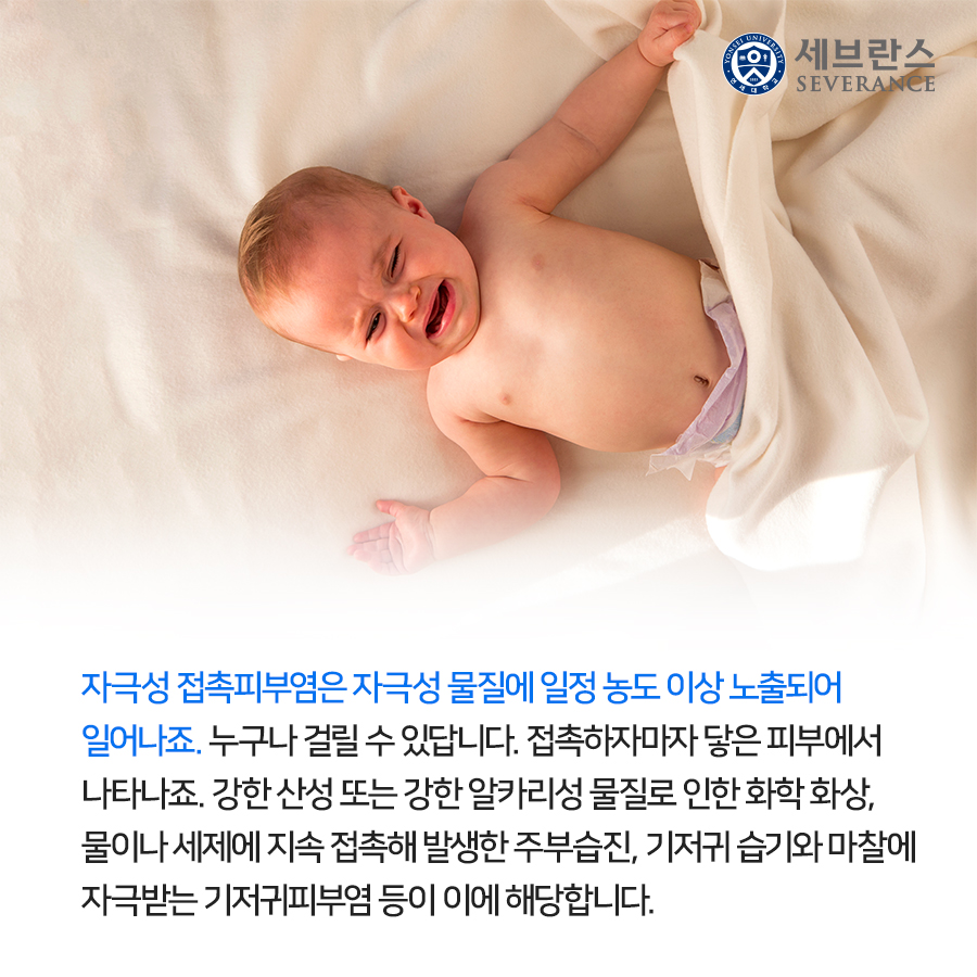 자극성 접촉피부염은 자극성 물질에 일정 농도 이상 노출되어 일어나죠. 누구나 걸릴 수 있답니다. 접촉하자마자 닿은 피부에서 나타나죠. 강한 산성 또는 강한 알카리성 물질로 인한 화학 화상, 물이나 세제에 지속 접촉해 발생한 주부습진, 기저귀 습기와 마찰에 자극받는 기저귀피부염 등이 이에 해당합니다. 