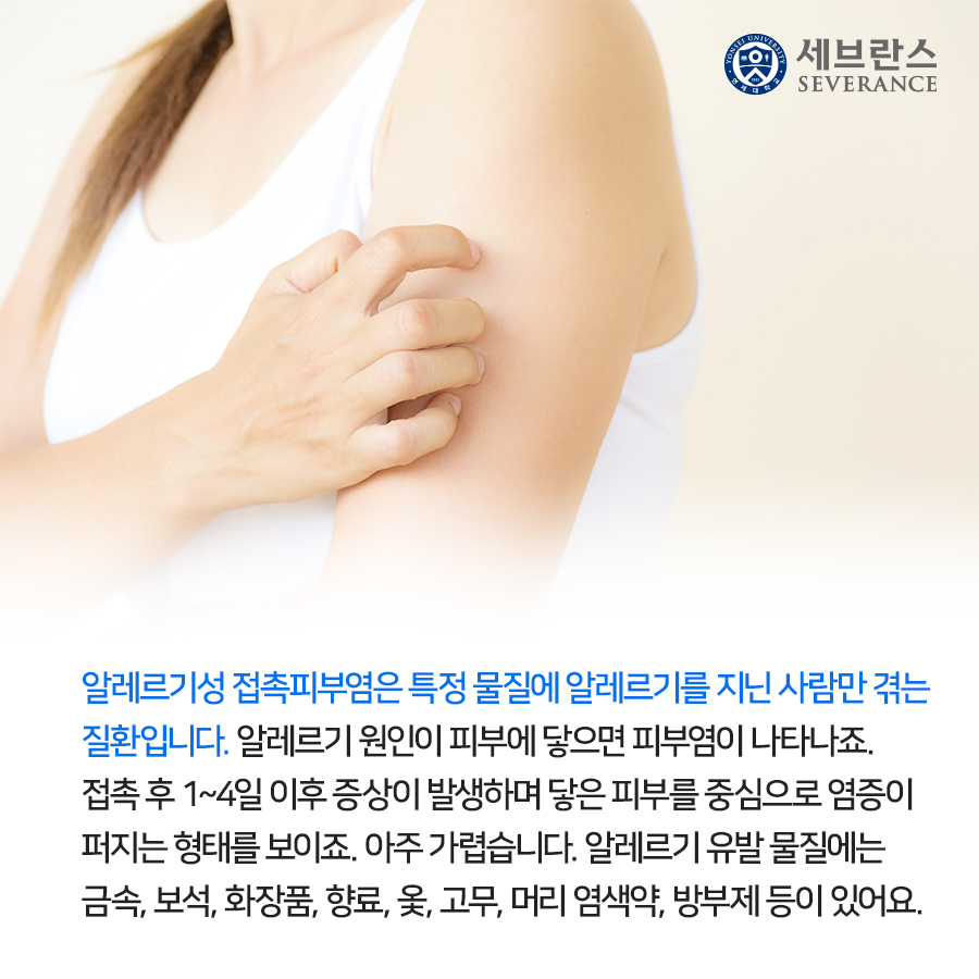 알레르기성 접촉피부염은 특정 물질에 알레르기를 지닌 사람만 겪는 질환입니다. 알레르기 원인이 피부에 닿으면 피부염이 나타나죠. 접촉 후 1~4일 이후 증상이 발생하며 닿은 피부를 중심으로 염증이 퍼지는 형태를 보이죠. 아주 가렵습니다. 알레르기 유발 물질에는 금속, 보석, 화장품, 향료, 옻, 고무, 머리 염색약, 방부제 등이 있어요.