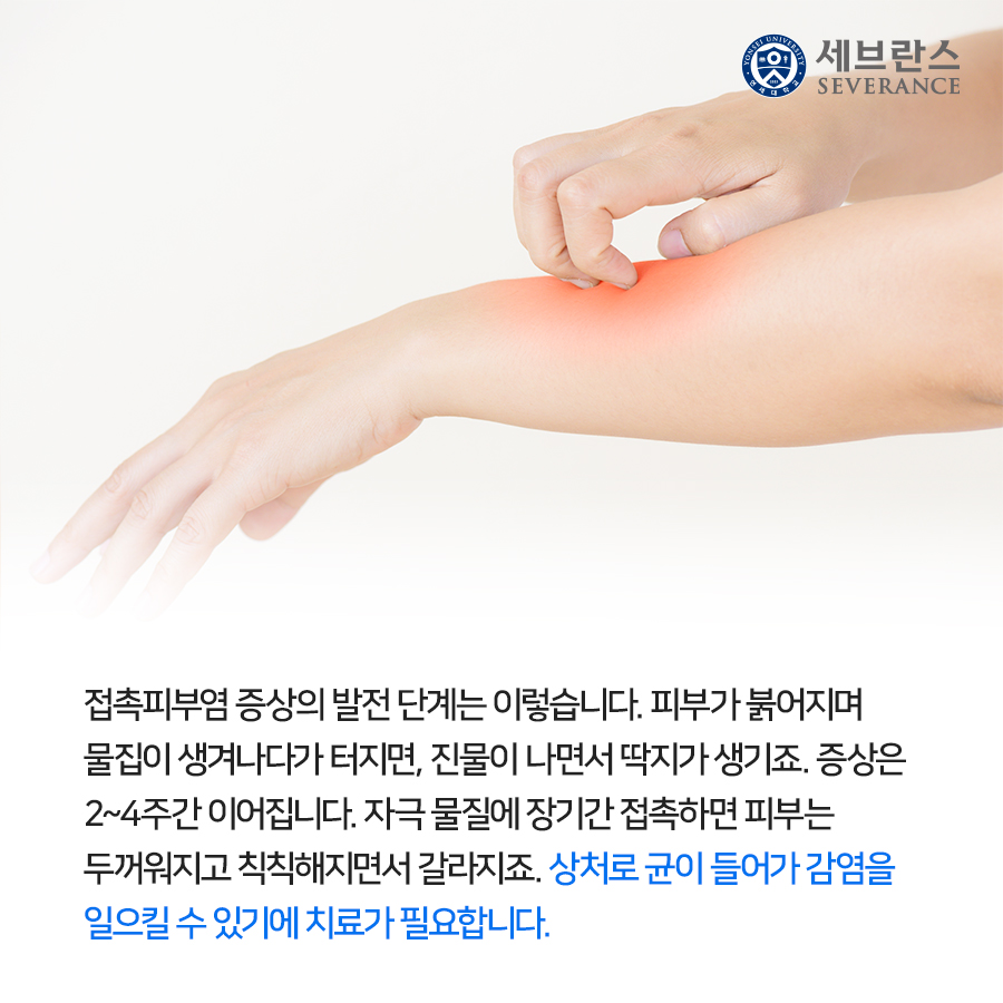 접촉피부염 증상의 발전 단계는 이렇습니다. 피부가 붉어지며 물집이 생겨나다가 터지면, 진물이 나면서 딱지가 생기죠. 증상은 2~4주간 이어집니다. 자극 물질에 장기간 접촉하면 피부는 두꺼워지고 칙칙해지면서 갈라지죠. 상처로 균이 들어가 감염을 일으킬 수 있기에 치료가 필요합니다.