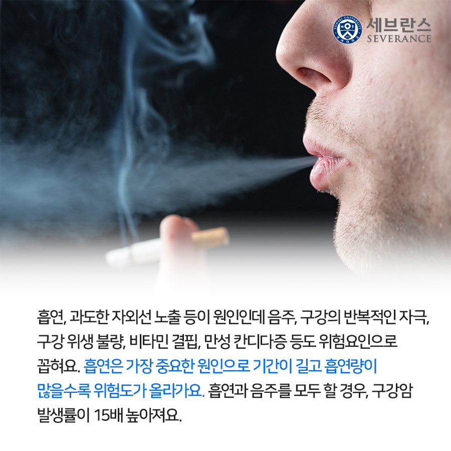 흡연, 과도한 자외선 노출 등이 원인인데 음주, 구강의 반복적인 자극, 구강 위생 불량, 비타민 결핍, 만성 칸디다증 등도 위험요인으로 꼽혀요. 흡연은 가장 중요한 원인으로 기간이 길고 흡연량이 많을수록 위험도가 올라가요. 흡연과 음주를 모두 할 경우, 구강암 발생률이 15배 높아져요.