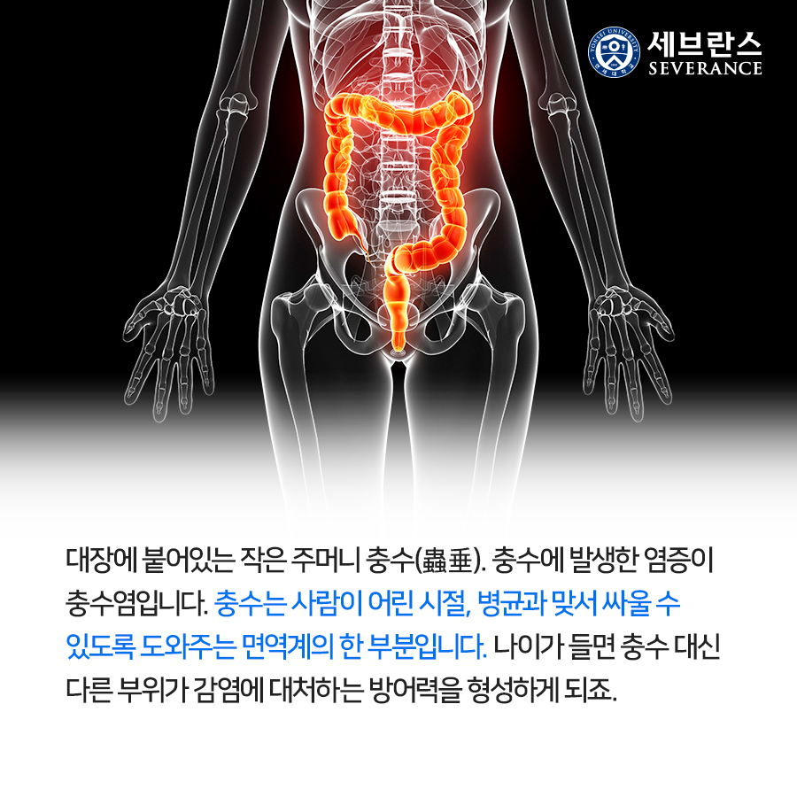 대장에 붙어있는 작은 주머니 충수(蟲垂). 충수에 발생한 염증이 충수염입니다. 충수는 사람이 어린 시절, 병균과 맞서 싸울 수 있도록 도와주는 면역계의 한 부분입니다. 나이가 들면 충수 대신 다른 부위가 감염에 대처하는 방어력을 형성하게 되죠.