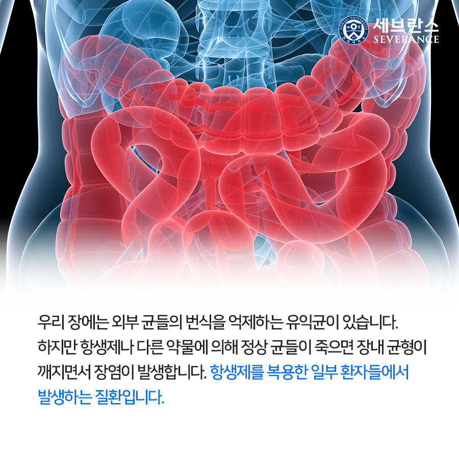 우리 장에는 외부 균들의 번식을 억제하는 유익균이 있습니다. 하지만 항생제나 다른 약물에 의해 정상 균들이 죽으면 장내 균형이 깨지면서 장염이 발생합니다. 항생제를 복용한 일부 환자들에서 발생하는 질환입니다.