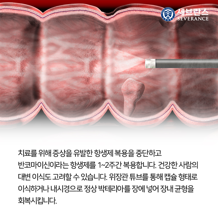 치료를 위해 증상을 유발한 항생제 복용을 중단하고 반코마이신이라는 항생제를 1~2주간 복용합니다. 건강한 사람의 대변 이식도 고려할 수 있습니다. 위장관 튜브를 통해 캡슐 형태로 이식하거나 내시경으로 정상 박테리아를 장에 넣어 장내 균 균형을 회복시킵니다.